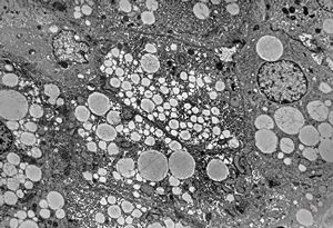 F,1y. | steatosis - Reye hepatocerebral syndrome